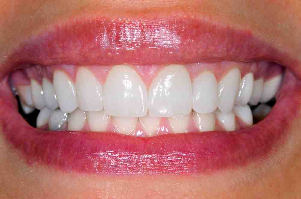 Do veneers last forever? Dental News Network