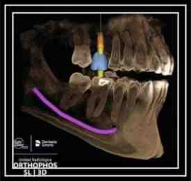 What are disadvantages of veneers?