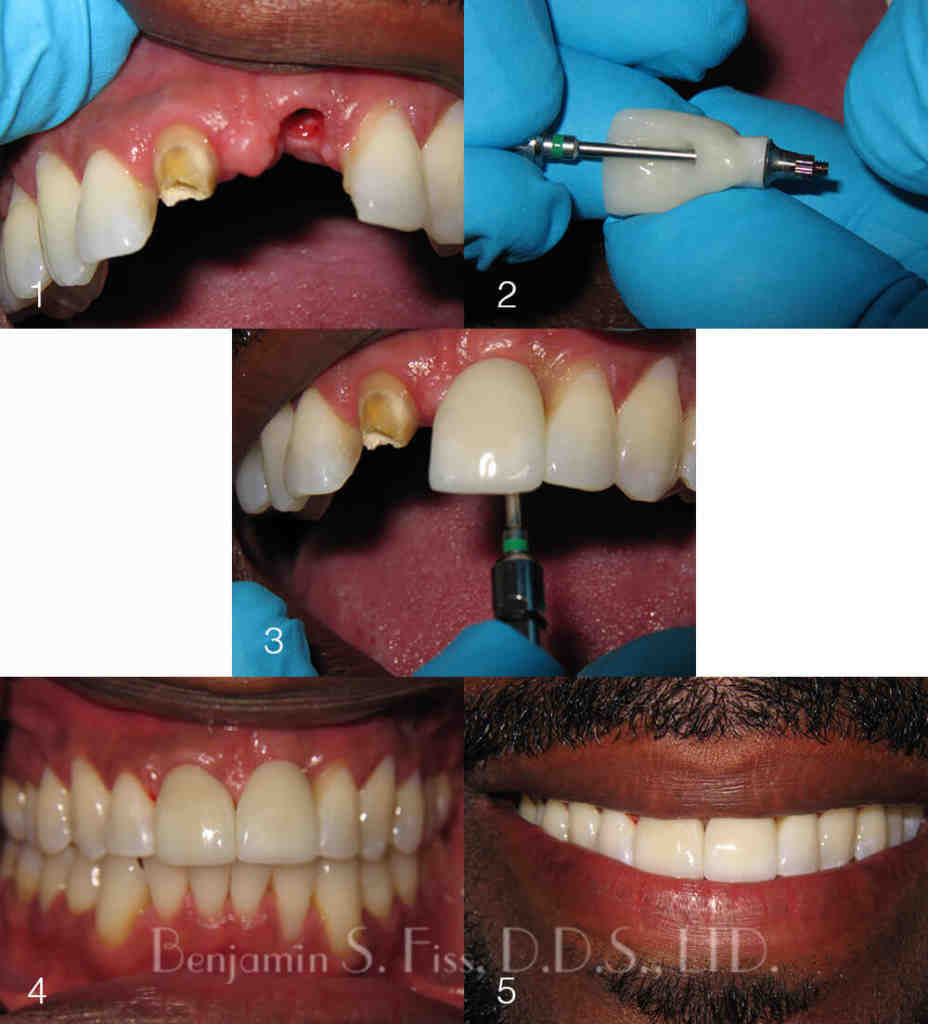 How to make your own dental implants Dental News Network