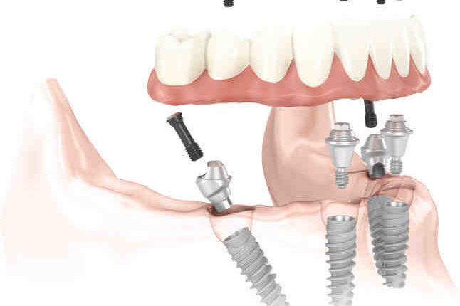 What are the best all on four dental implants