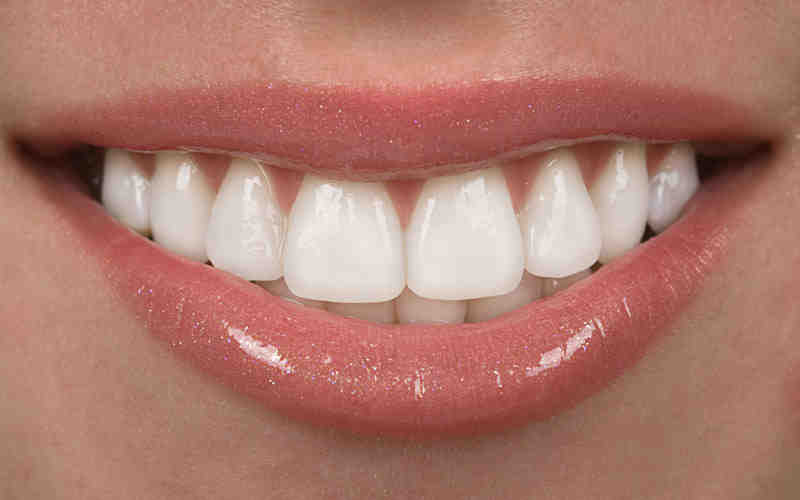 How long do tooth veneers last? Dental News Network