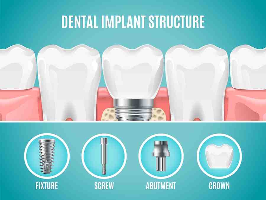 What are the long term effects of dental implants?