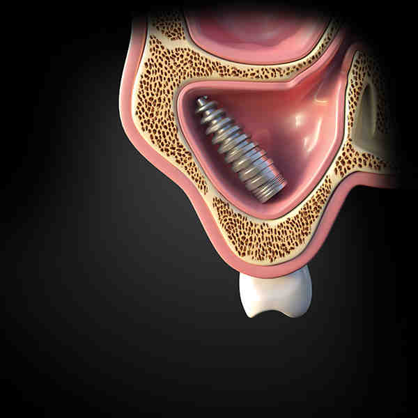 What if dental implant goes in sinus cavity Dental News Network