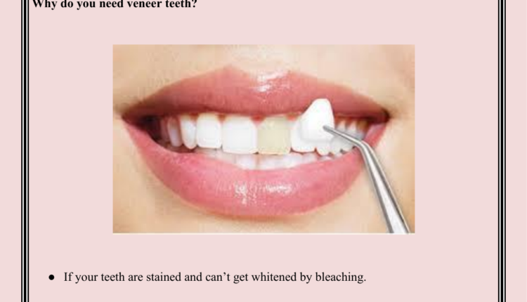 What are veneers teeth made of?