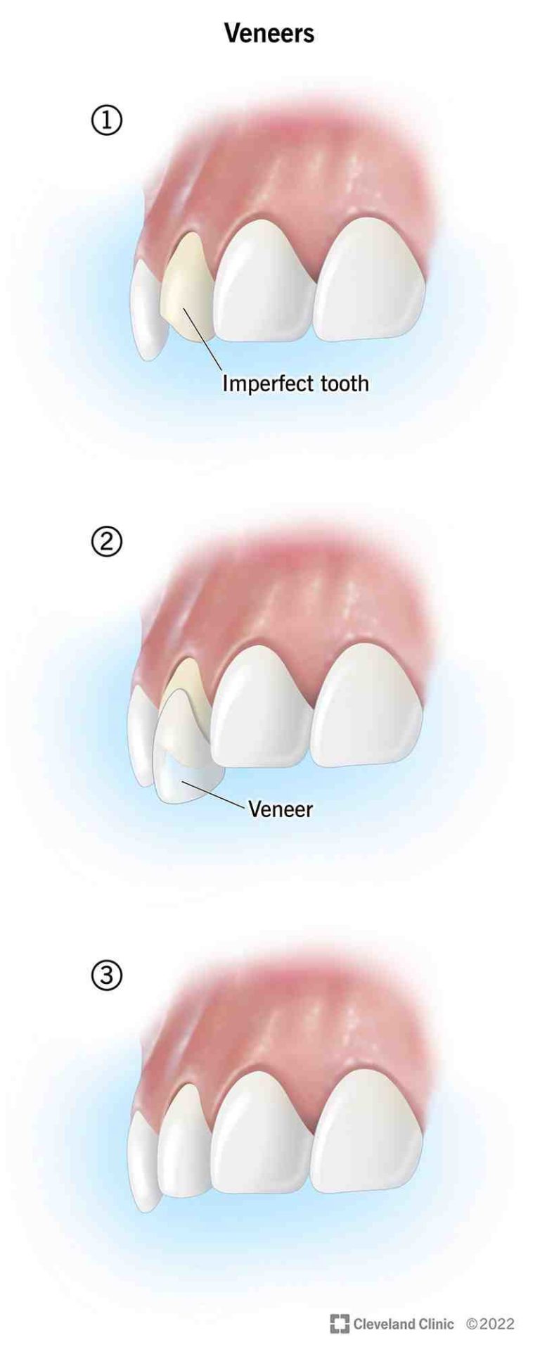 Do veneers come off? Dental News Network
