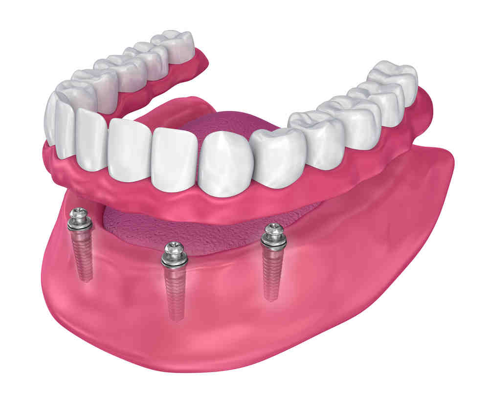 What causes a dental implant to fail?