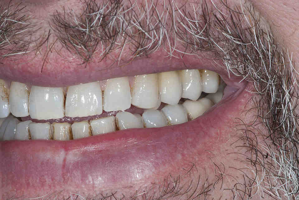 How do they uncover dental implants Dental News Network