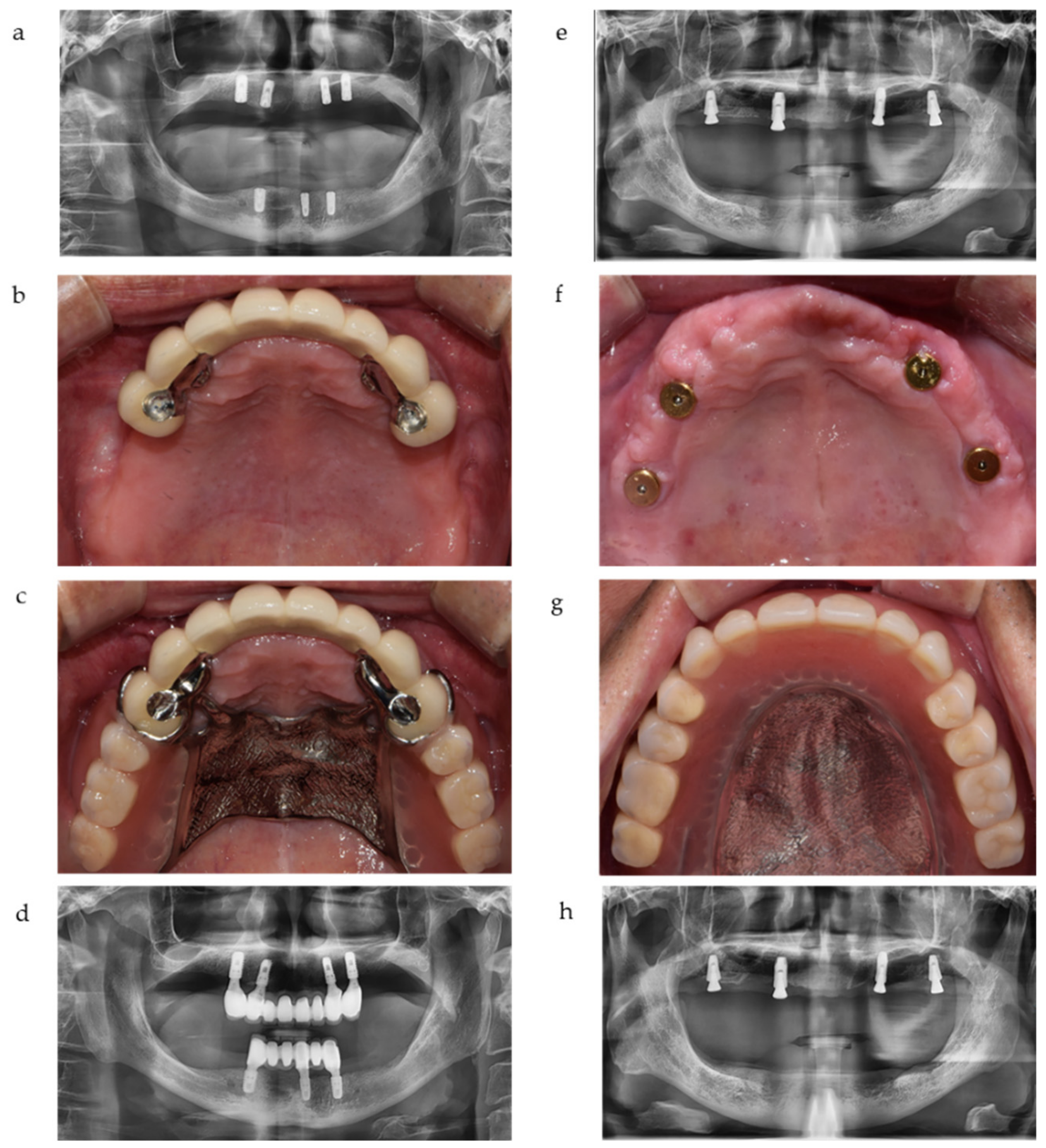 What dental services are covered by Medicare?
