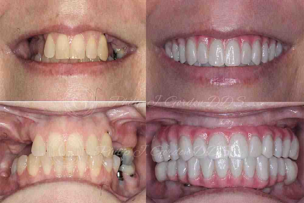 How long to install dental implants for whole mouth Dental News Network