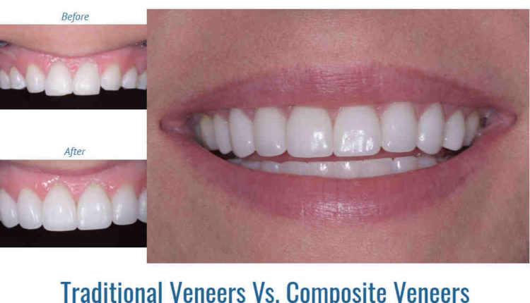 What do they do to your teeth for veneers?