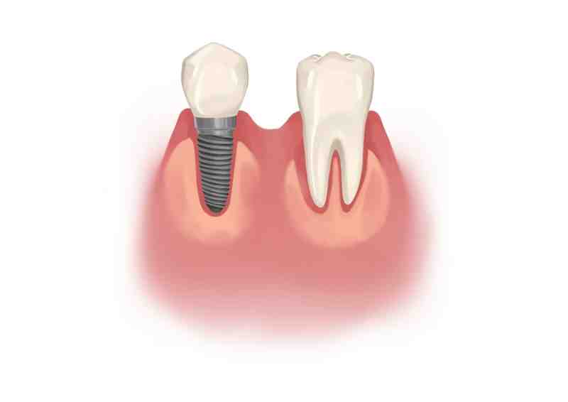 What does a failed dental implant feel like?