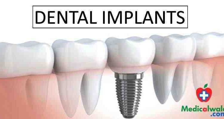 What does clear choice dental implants cist