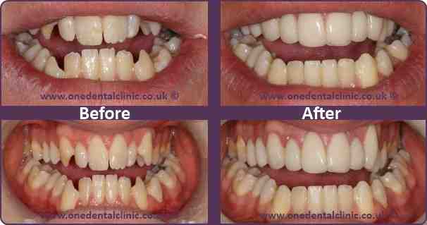 What happens to your original teeth with veneers?
