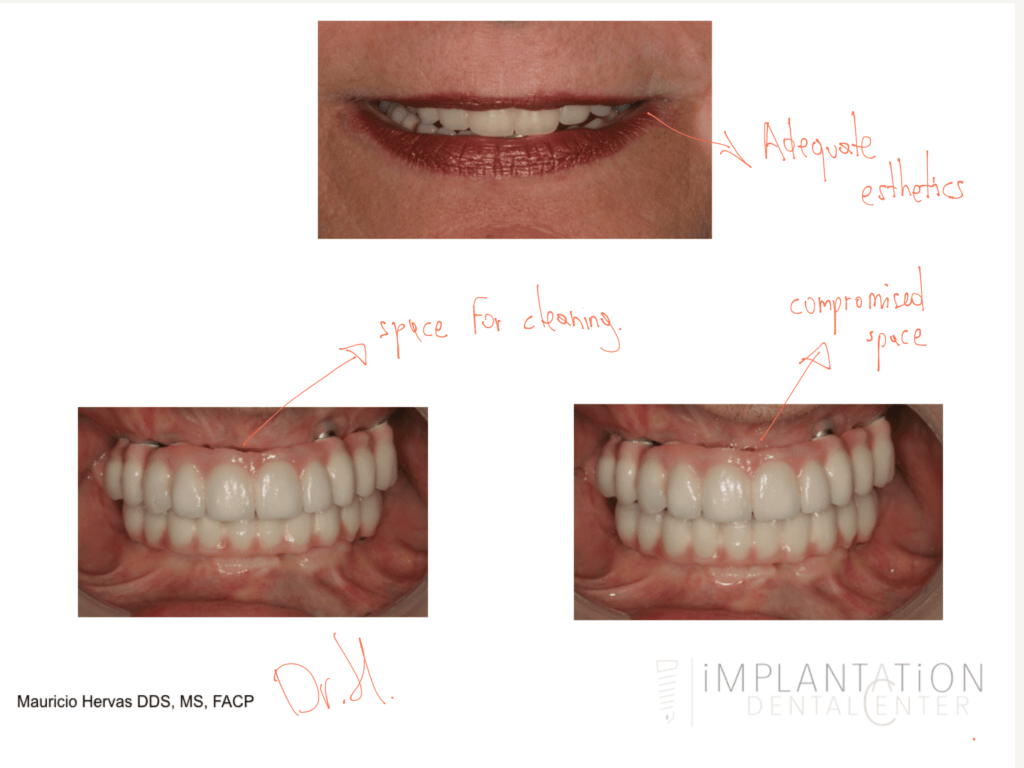 What happens when an implant is removed?