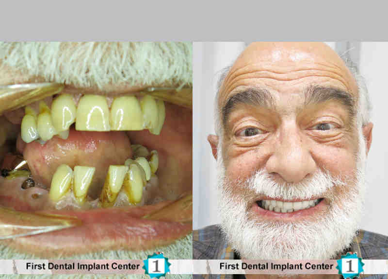 Can you shave dental implant Dental News Network