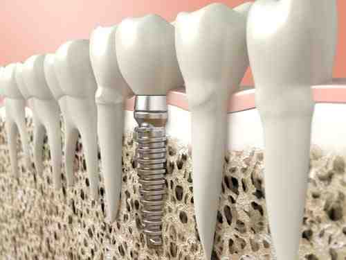 What hurts more tooth extraction or implant?