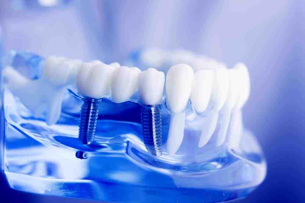 What is a abutment screw?