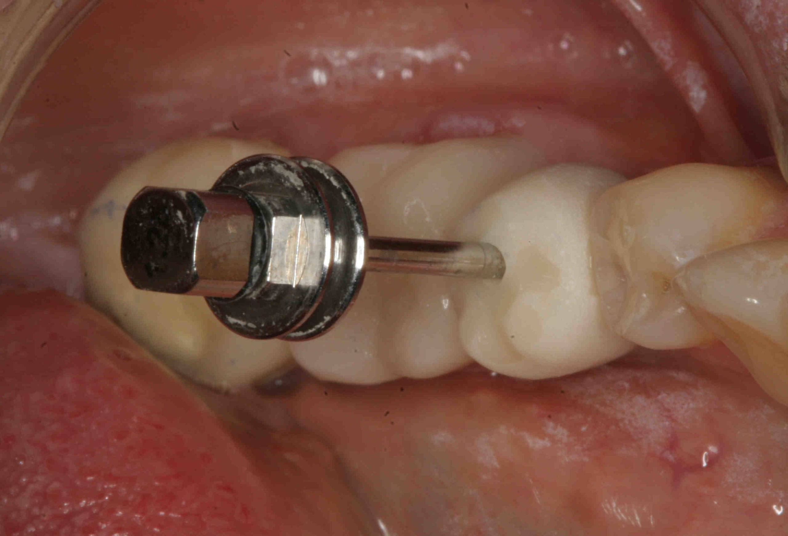 How to cove screw access holes on dental implant crown Dental News