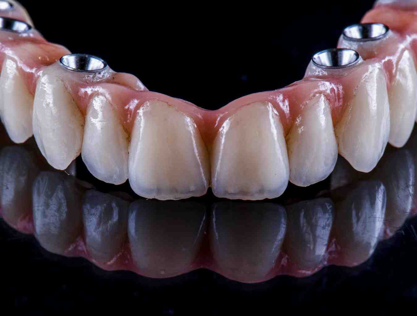 What is better an implant or a bridge?
