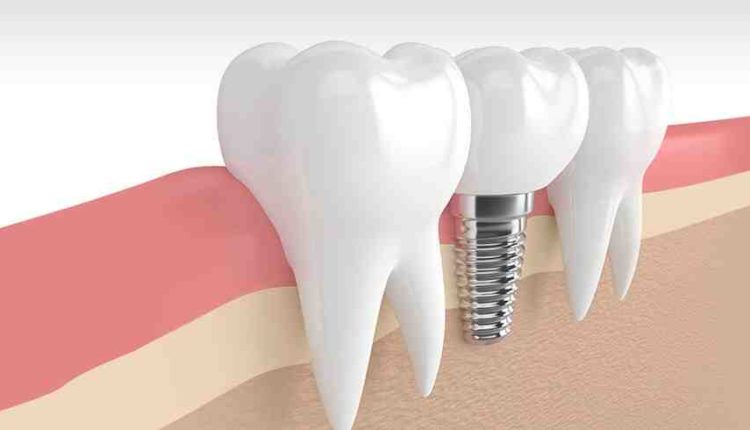 What is dental implants and who can do dental implants