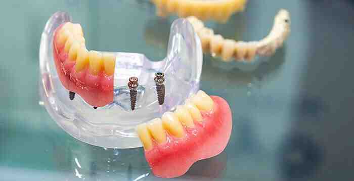 What is the best option to replace a molar tooth?