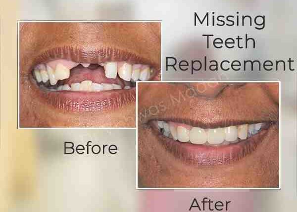 What is the cheapest way to replace a missing tooth?