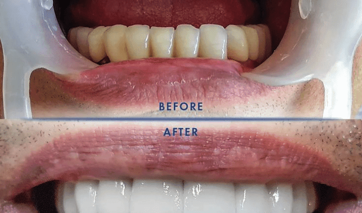 What is the cost of full mouth dental implants in mexico?
