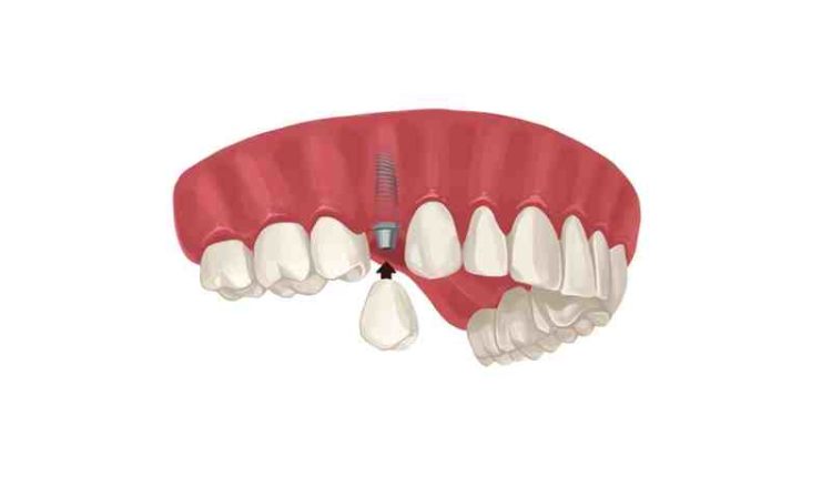 What is the credit score range to get dental implants financing