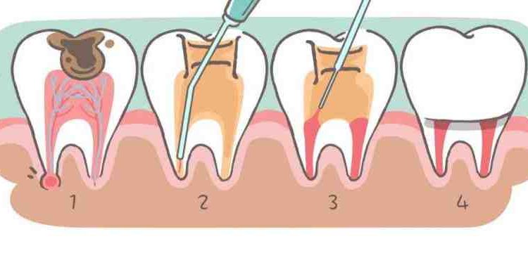 What is the difference between dental implant and root canal