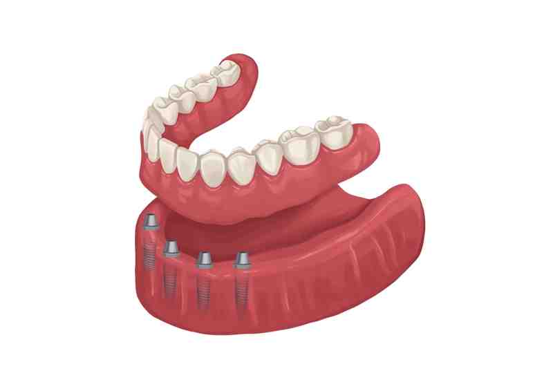 What is the failure rate of dental implants?