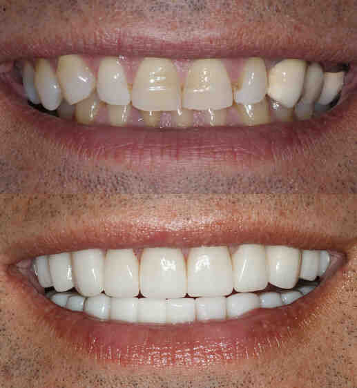 What is the whitest shade of teeth veneers?