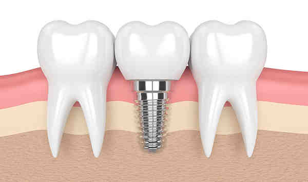 What maintenance is required for dental implants?