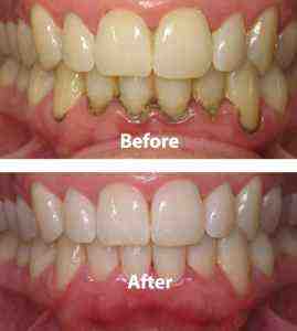 What percentage of adults have periodontal disease?