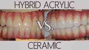 What they don't tell you about dental implants?