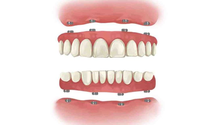 What to expect with all-on-4 dental implants