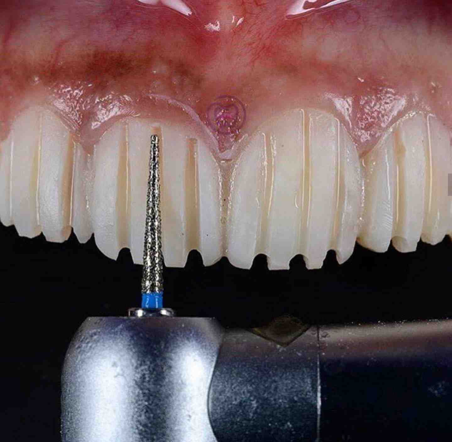 What toothpaste is best for veneers?