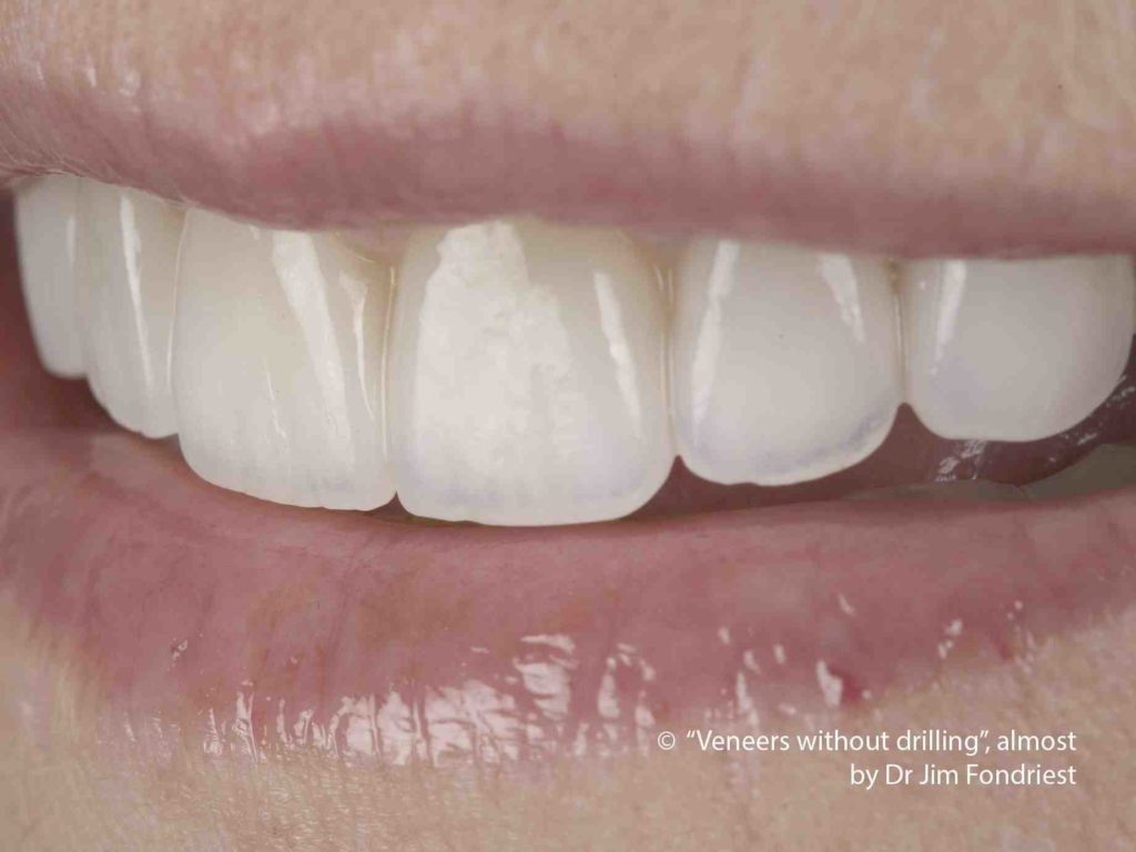 Do they shave your teeth for veneers? Dental News Network