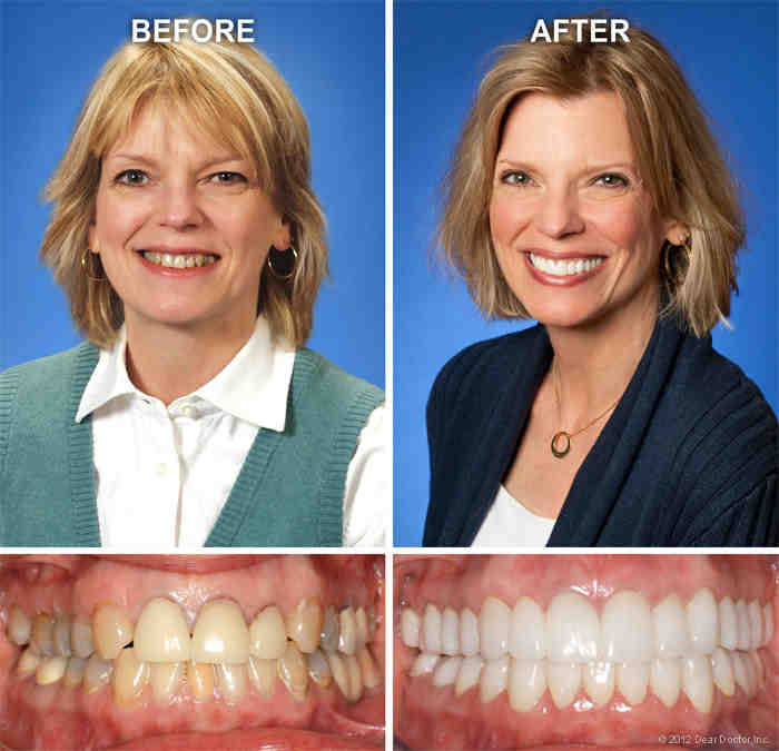 What's better Lumineers or veneers?