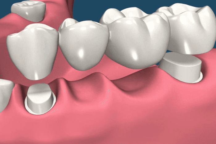 Whats better implants or crowns?