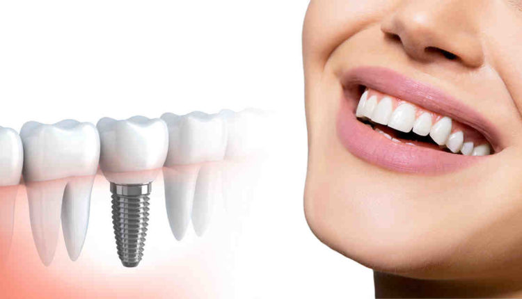 When is a dental implant necessary