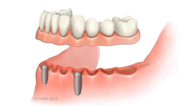 Where would a women of 77 yrs old get help with dental implants