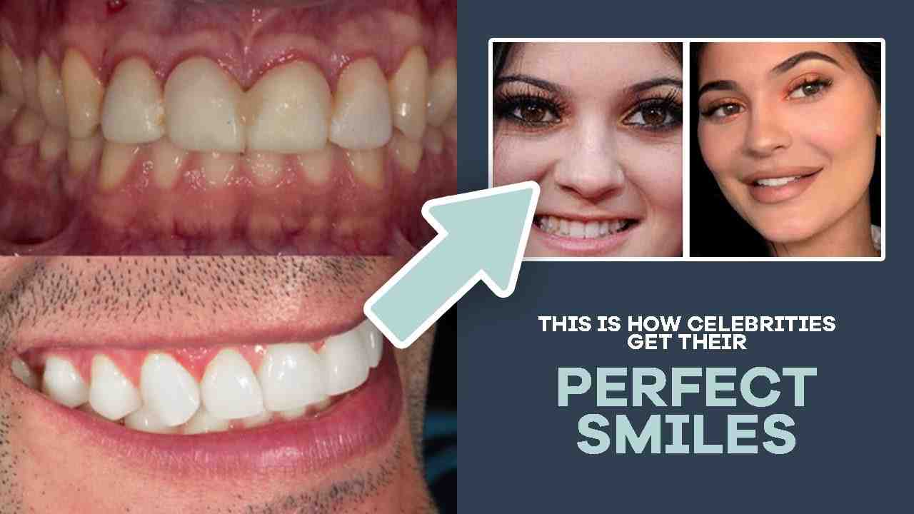 Do all celebrities have veneers? Dental News Network