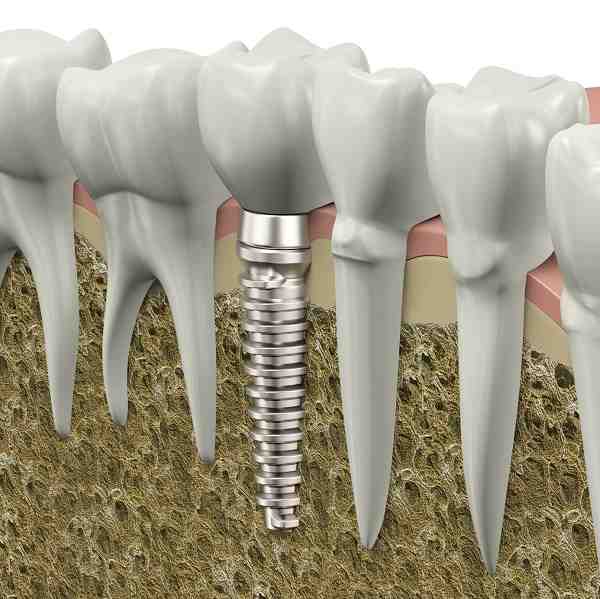 Which is better all on 4 or all on 6 dental implants?