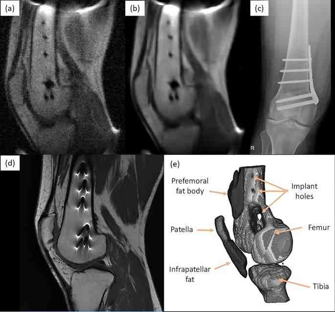 Can you have an mri or pet scan if you have dental implants Dental