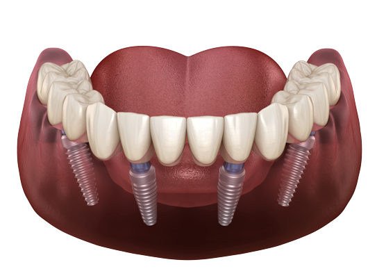 Who is not a candidate for All-on-4 dental implants?