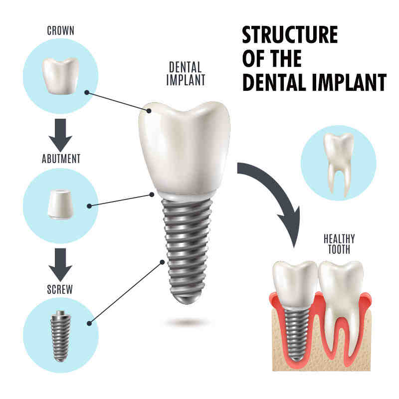 Who is not a candidate for dental implants?