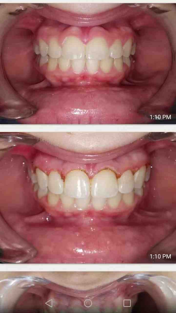 How much dental implant reddit Dental News Network
