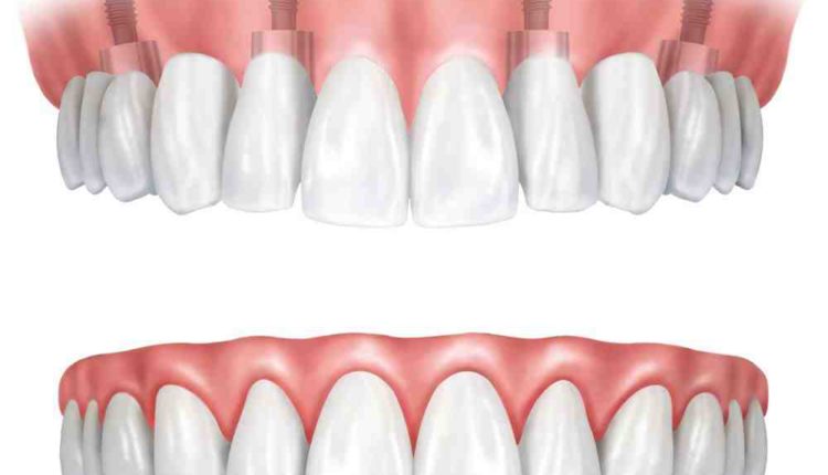 Who is qualified to do dental implants