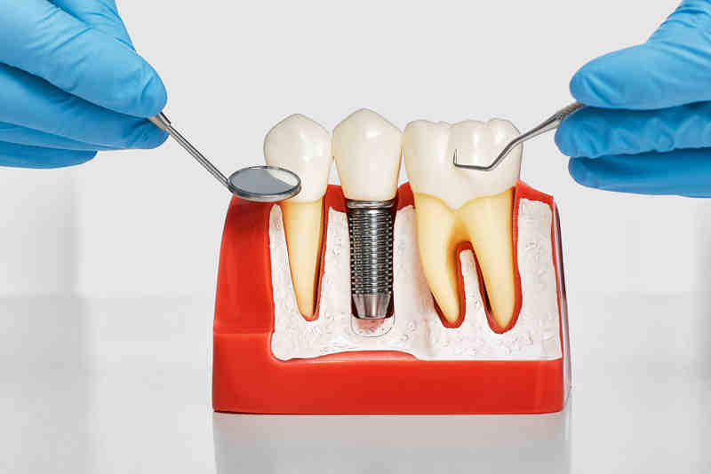 Why am I losing bone around my dental implant?