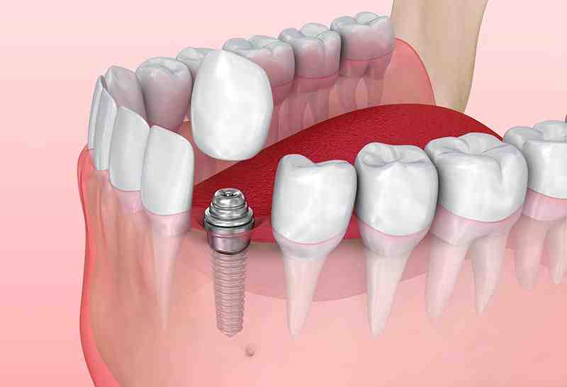 Why am I so tired after dental implants?